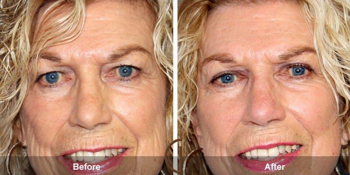 Eyelid Lift Before & After Gallery - Patient 150177 - Image 1