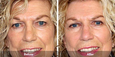 Eyelid Lift Before & After Gallery - Patient 150177 - Image 1