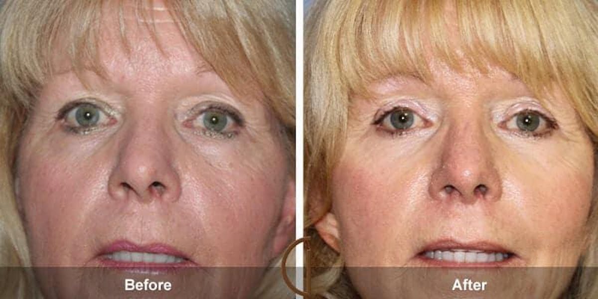 Eyelid Lift Before & After Gallery - Patient 394282 - Image 1