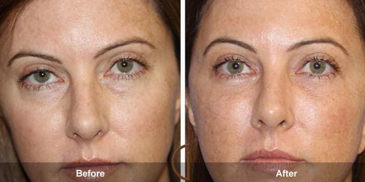 Eyelid Lift Before & After Gallery - Patient 301837 - Image 1