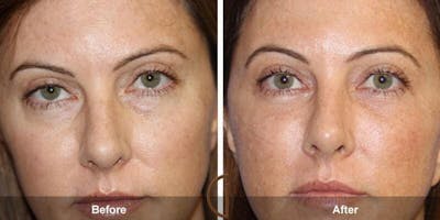 Eyelid Lift Before & After Gallery - Patient 301837 - Image 1