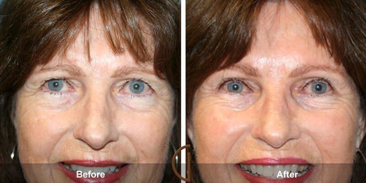 Eyelid Lift Before & After Gallery - Patient 318969 - Image 1