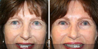 Eyelid Lift Before & After Gallery - Patient 318969 - Image 1
