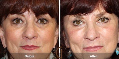 Eyelid Lift Before & After Gallery - Patient 374741 - Image 1