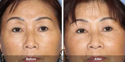 Eyelid Lift Before & After Gallery - Patient 389797 - Image 1