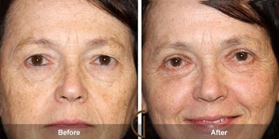 Eyelid Lift Before & After Gallery - Patient 312245 - Image 1