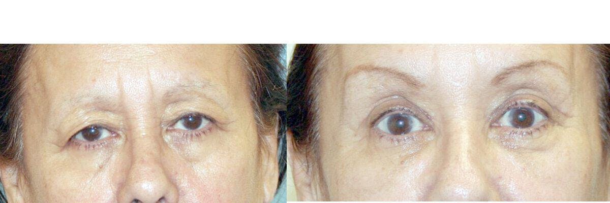 Eyelid Lift Before & After Gallery - Patient 312070 - Image 1