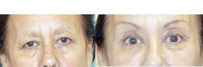 Eyelid Lift Before & After Gallery - Patient 312070 - Image 1