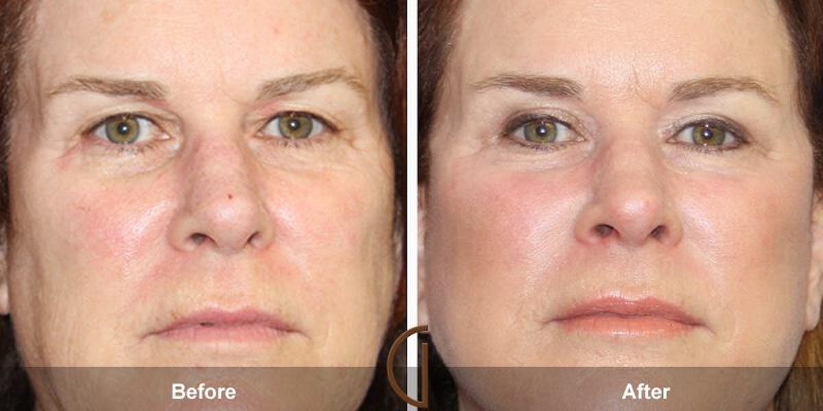 Eyelid Lift Before & After Gallery - Patient 368772 - Image 1