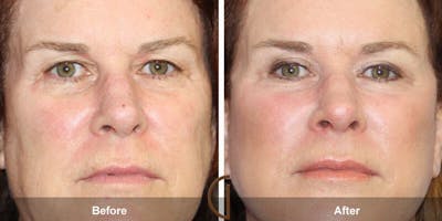 Eyelid Lift Before & After Gallery - Patient 368772 - Image 1