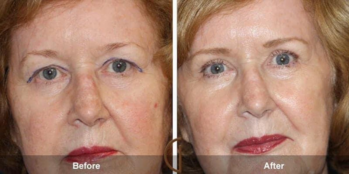 Eyelid Lift Before & After Gallery - Patient 404563 - Image 1