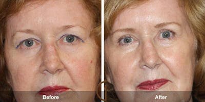 Eyelid Lift Before & After Gallery - Patient 404563 - Image 1