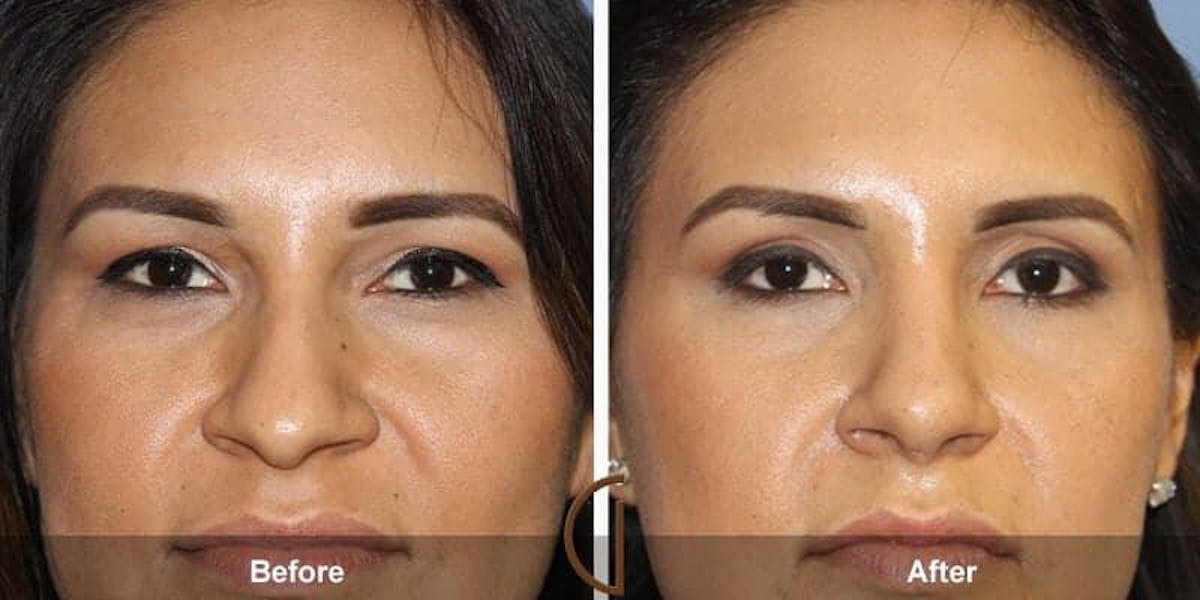 Eyelid Lift Before & After Gallery - Patient 817777 - Image 1