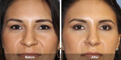 Eyelid Lift Before & After Gallery - Patient 817777 - Image 1