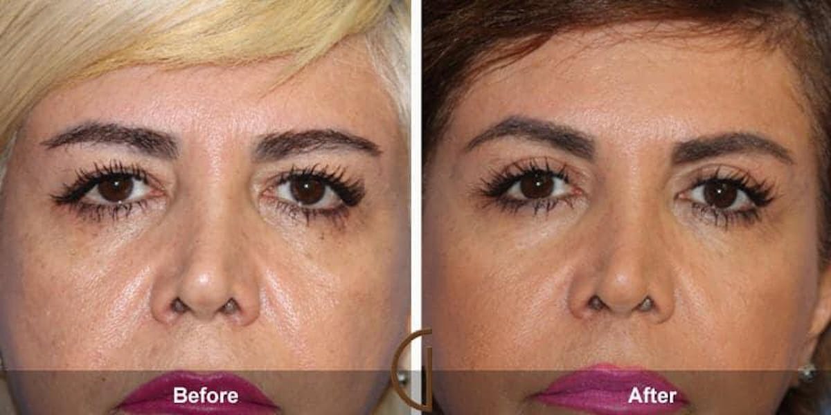 Eyelid Lift Before & After Gallery - Patient 230592 - Image 1