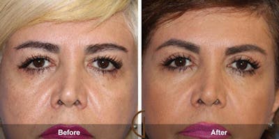 Eyelid Lift Before & After Gallery - Patient 230592 - Image 1