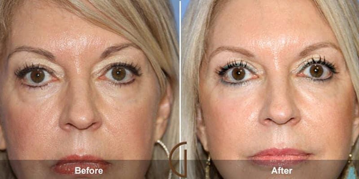 Eyelid Lift Before & After Gallery - Patient 440714 - Image 1