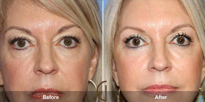 Eyelid Lift Before & After Gallery - Patient 440714 - Image 1