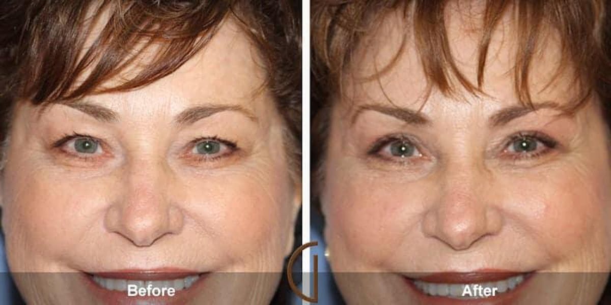 Eyelid Lift Before & After Gallery - Patient 221167 - Image 1