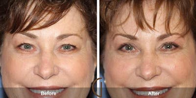 Eyelid Lift Before & After Gallery - Patient 221167 - Image 1