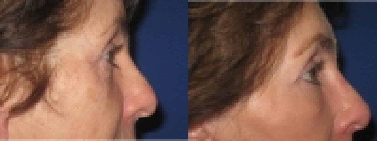 Eyelid Lift Before & After Gallery - Patient 222989 - Image 1