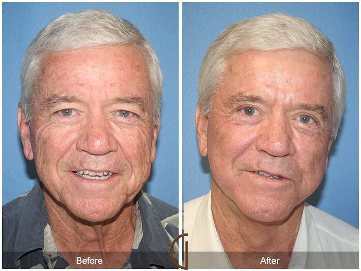 Eyelid Lift Before & After Gallery - Patient 399372 - Image 2