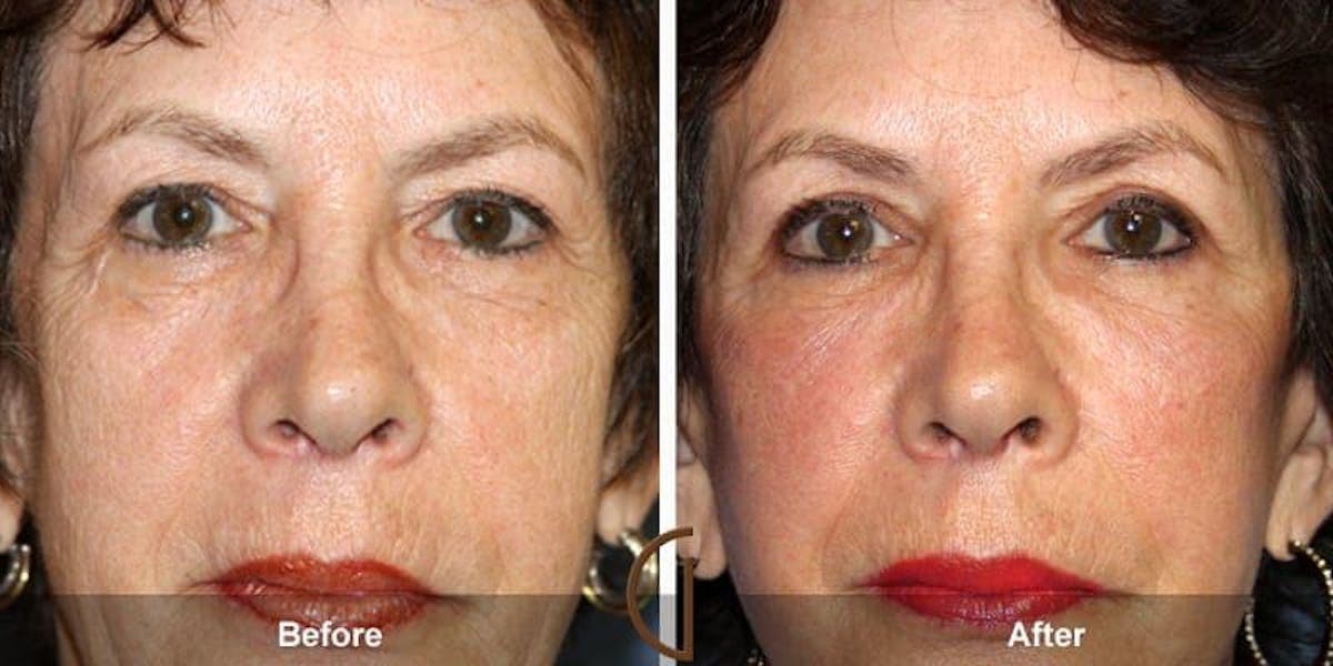 Eyelid Lift Before & After Gallery - Patient 241674 - Image 1