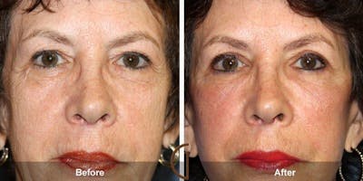 Eyelid Lift Before & After Gallery - Patient 241674 - Image 1
