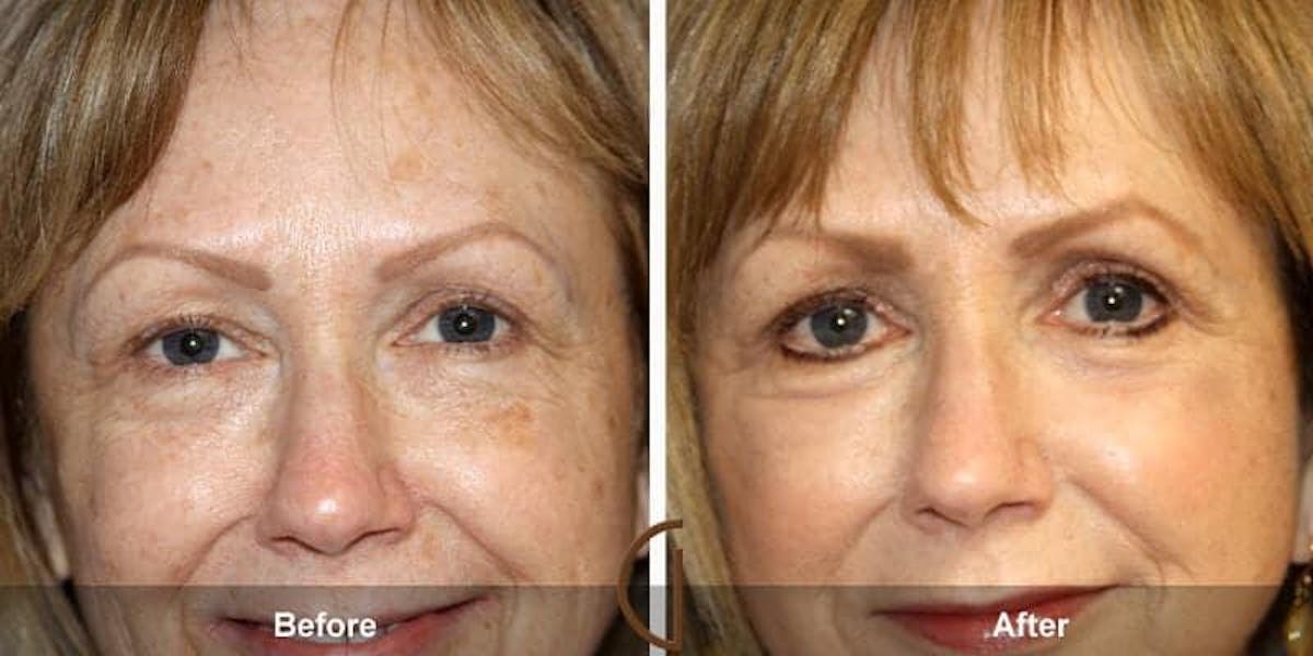 Eyelid Lift Before & After Gallery - Patient 331346 - Image 1