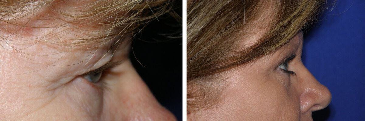 Eyelid Lift Before & After Gallery - Patient 158911 - Image 1