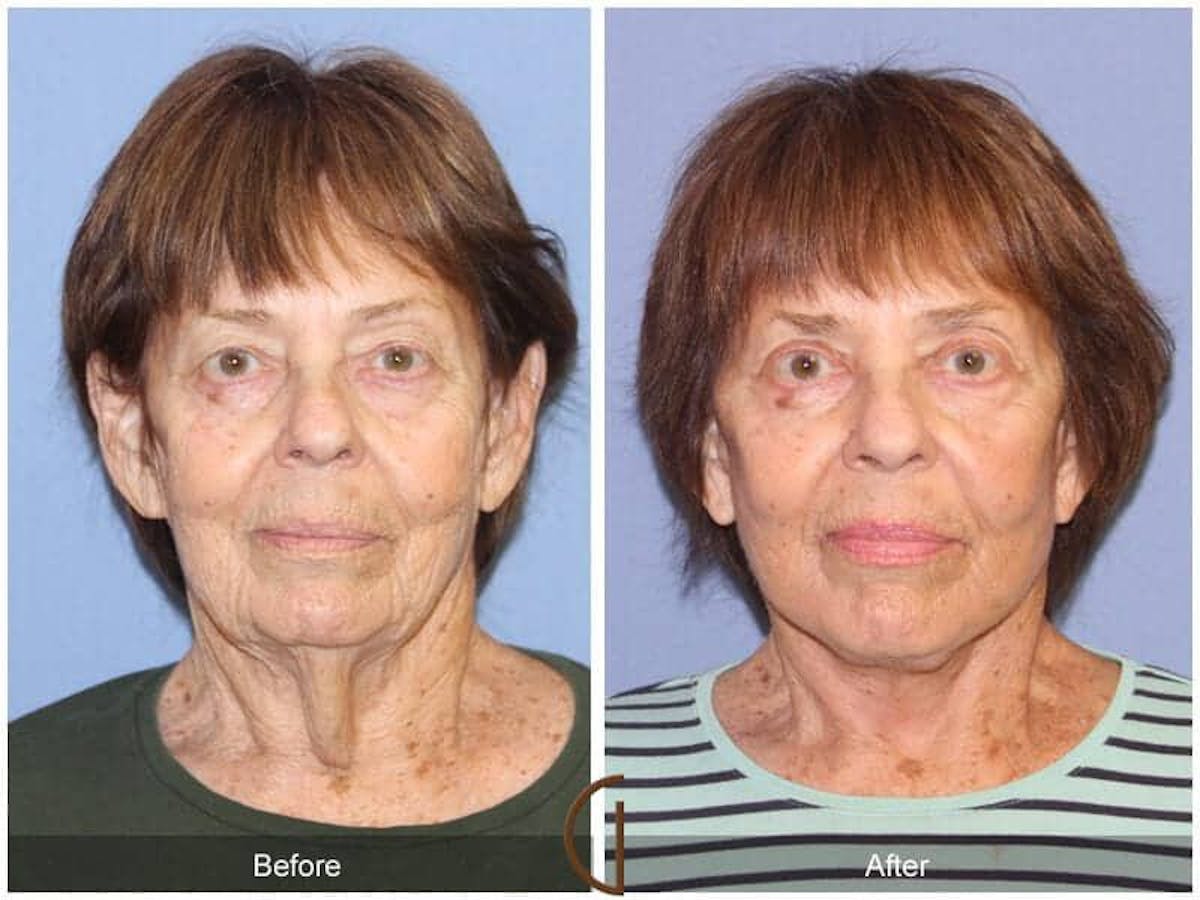Eyelid Lift Before & After Gallery - Patient 147681 - Image 2