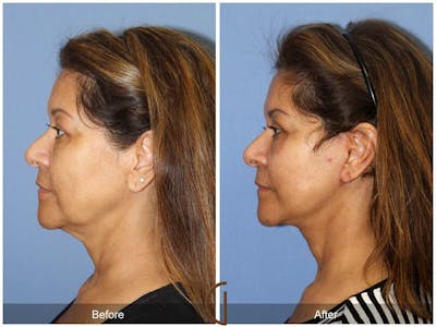 Eyelid Lift Before & After Gallery - Patient 325118 - Image 1