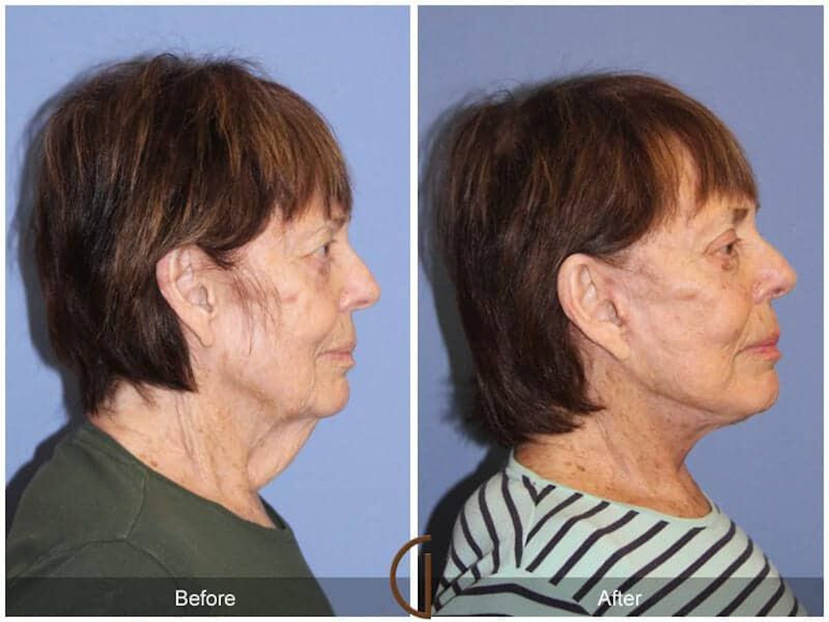 Eyelid Lift Before & After Gallery - Patient 147681 - Image 3