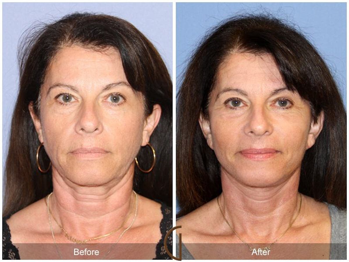 Eyelid Lift Before & After Gallery - Patient 261897 - Image 2