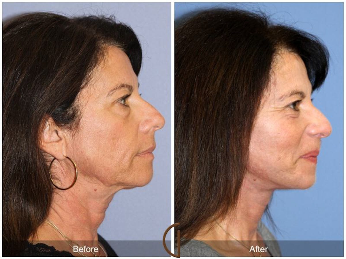 Eyelid Lift Before & After Gallery - Patient 261897 - Image 3