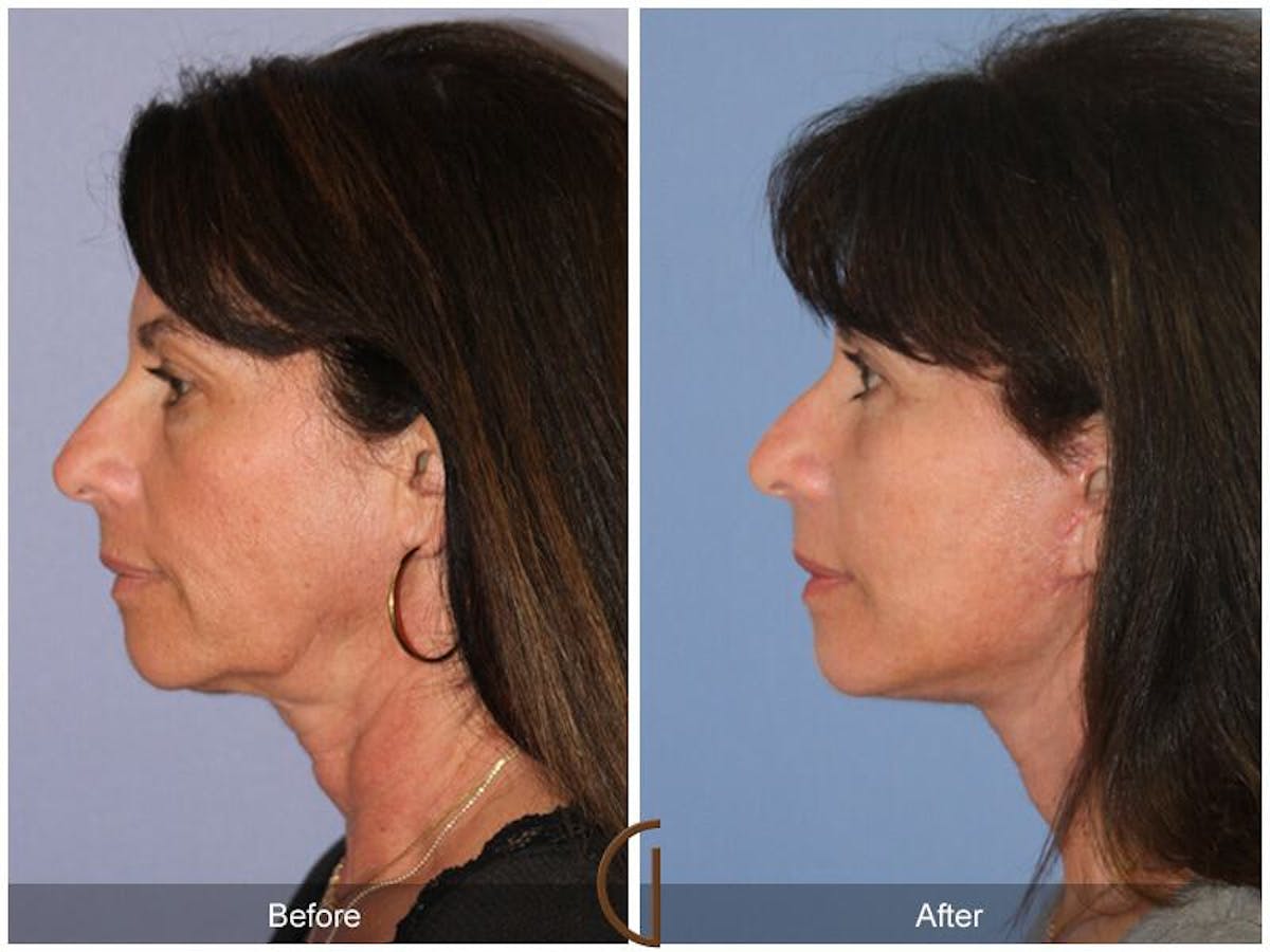 Eyelid Lift Before & After Gallery - Patient 261897 - Image 1