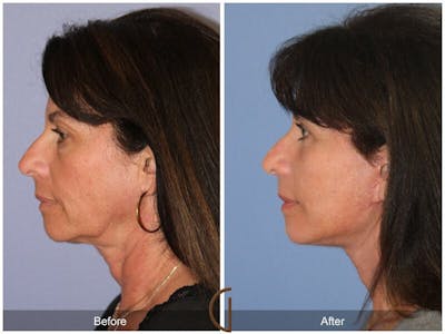Eyelid Lift Before & After Gallery - Patient 261897 - Image 1