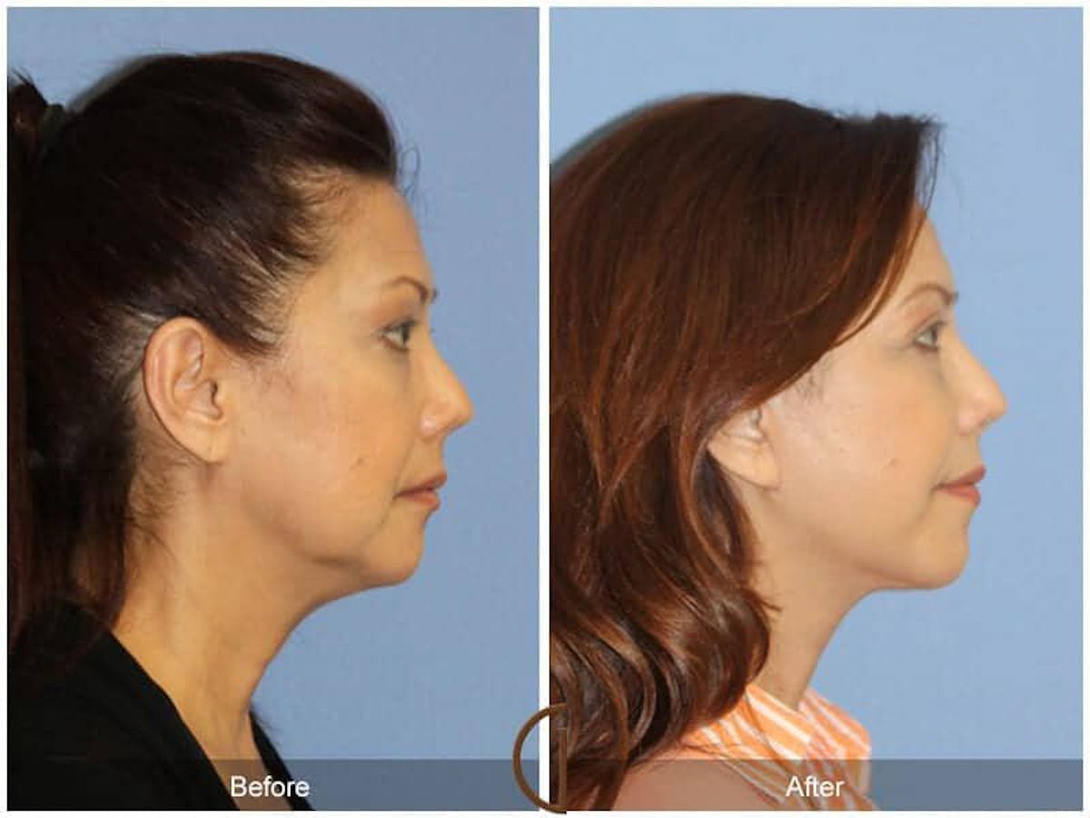 Eyelid Lift Before & After Gallery - Patient 354410 - Image 3