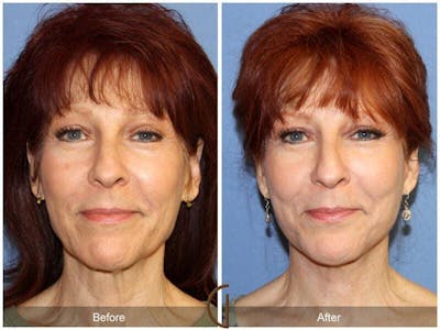 Eyelid Lift Before & After Gallery - Patient 219556 - Image 1