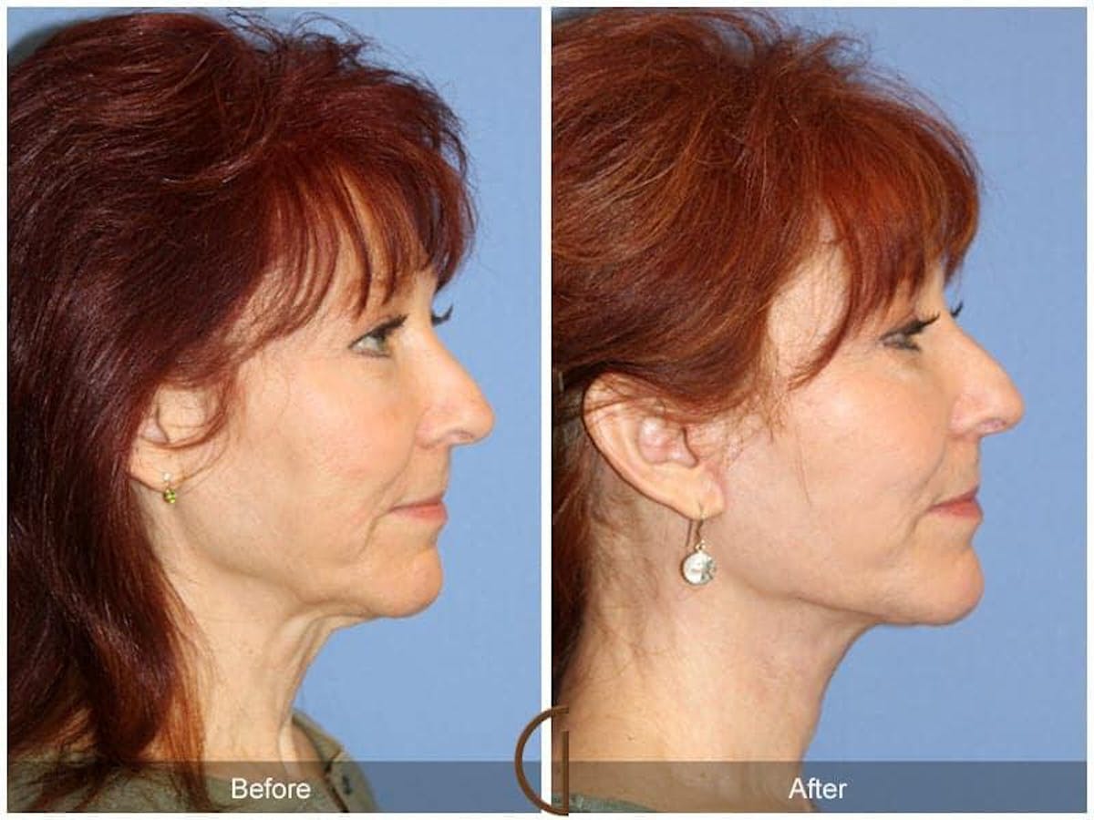 Eyelid Lift Before & After Gallery - Patient 219556 - Image 2