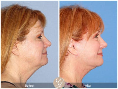 Eyelid Lift Before & After Gallery - Patient 868770 - Image 1