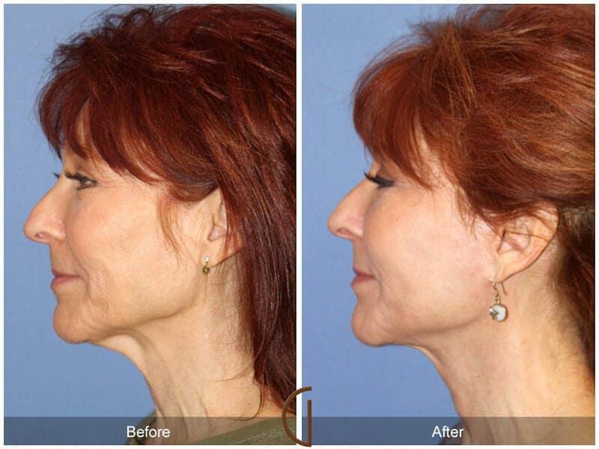 Eyelid Lift Before & After Gallery - Patient 219556 - Image 3