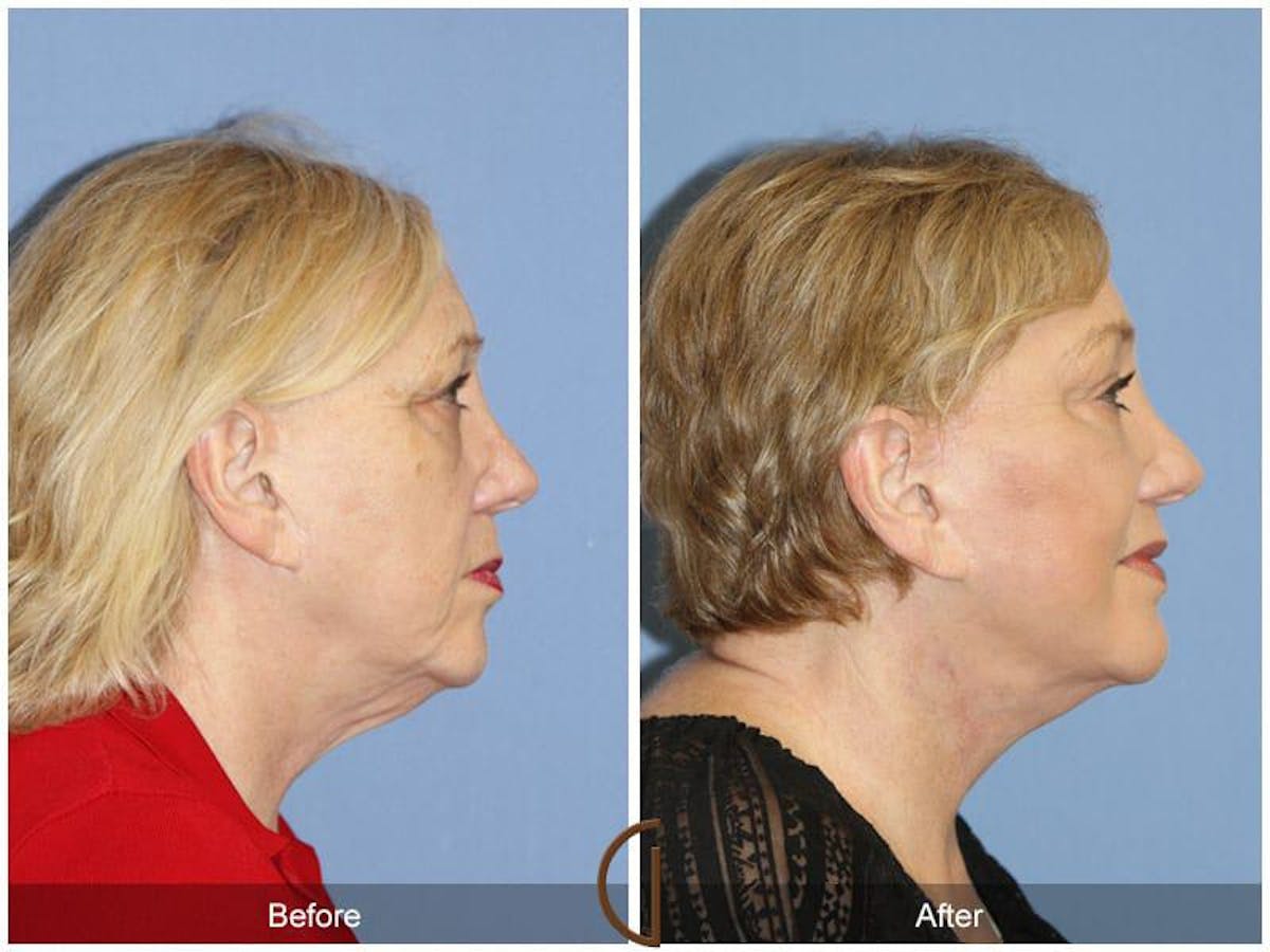 Eyelid Lift Before & After Gallery - Patient 237526 - Image 3