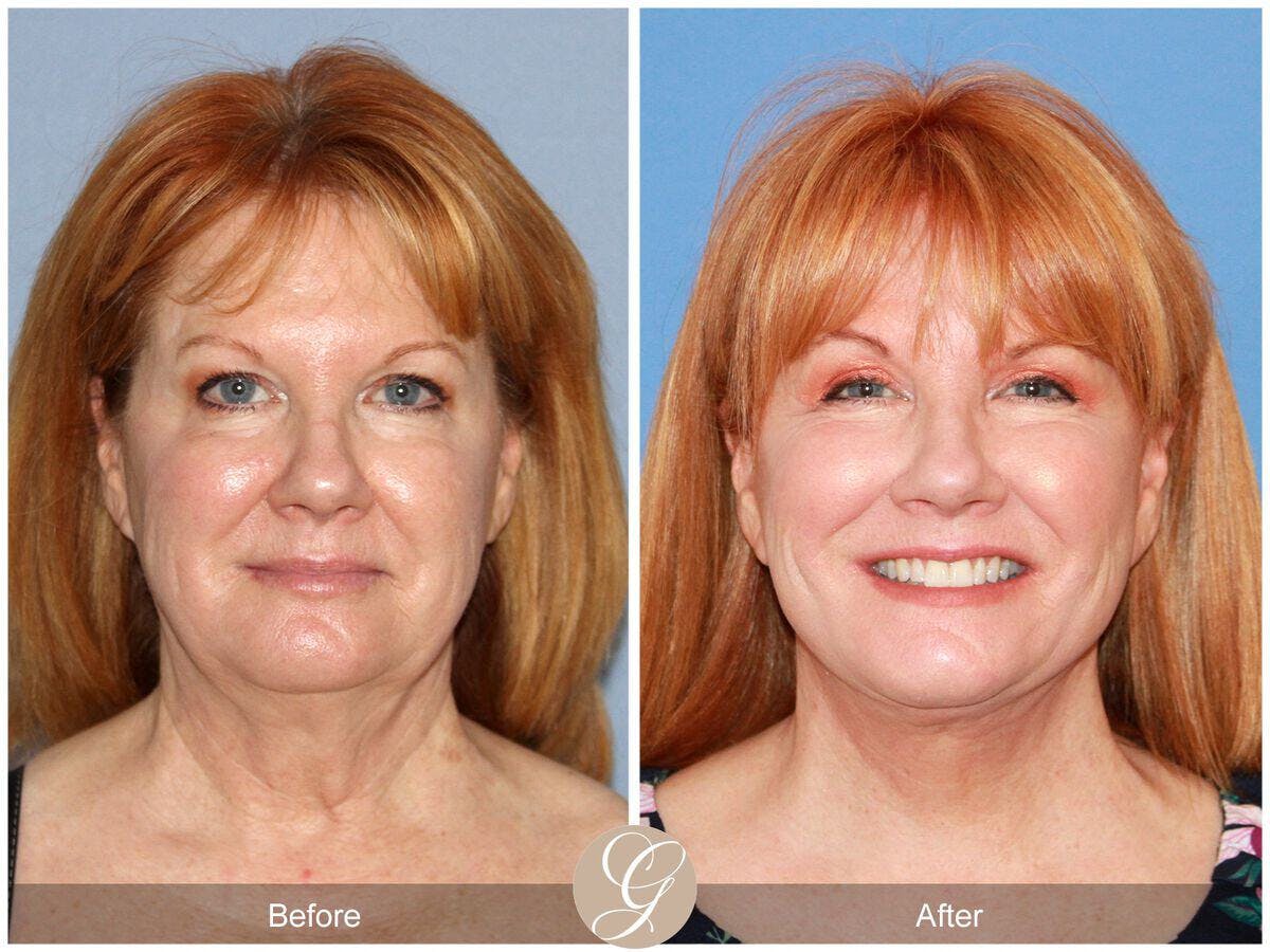 Eyelid Lift Before & After Gallery - Patient 868770 - Image 2