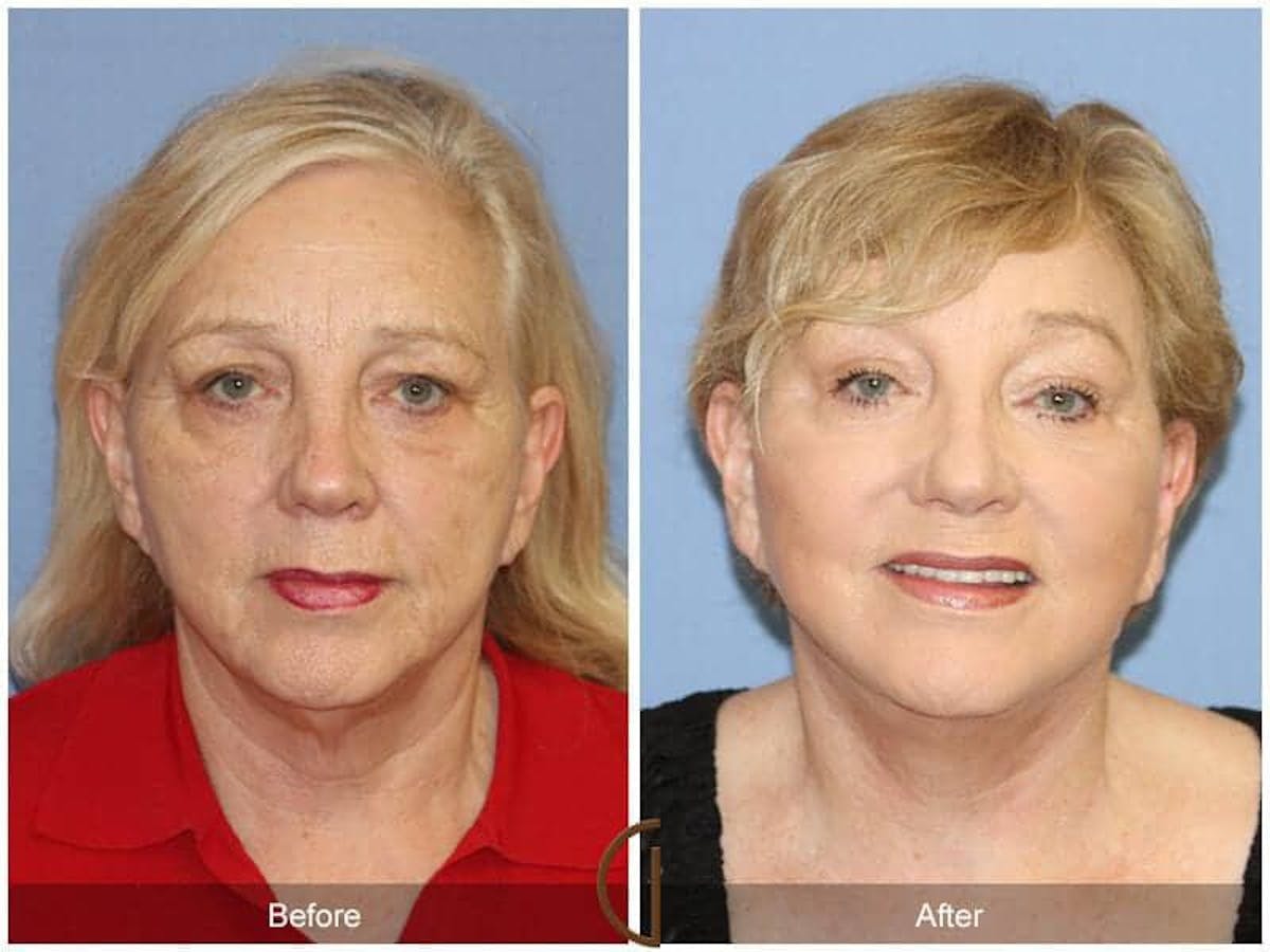 Eyelid Lift Before & After Gallery - Patient 237526 - Image 2