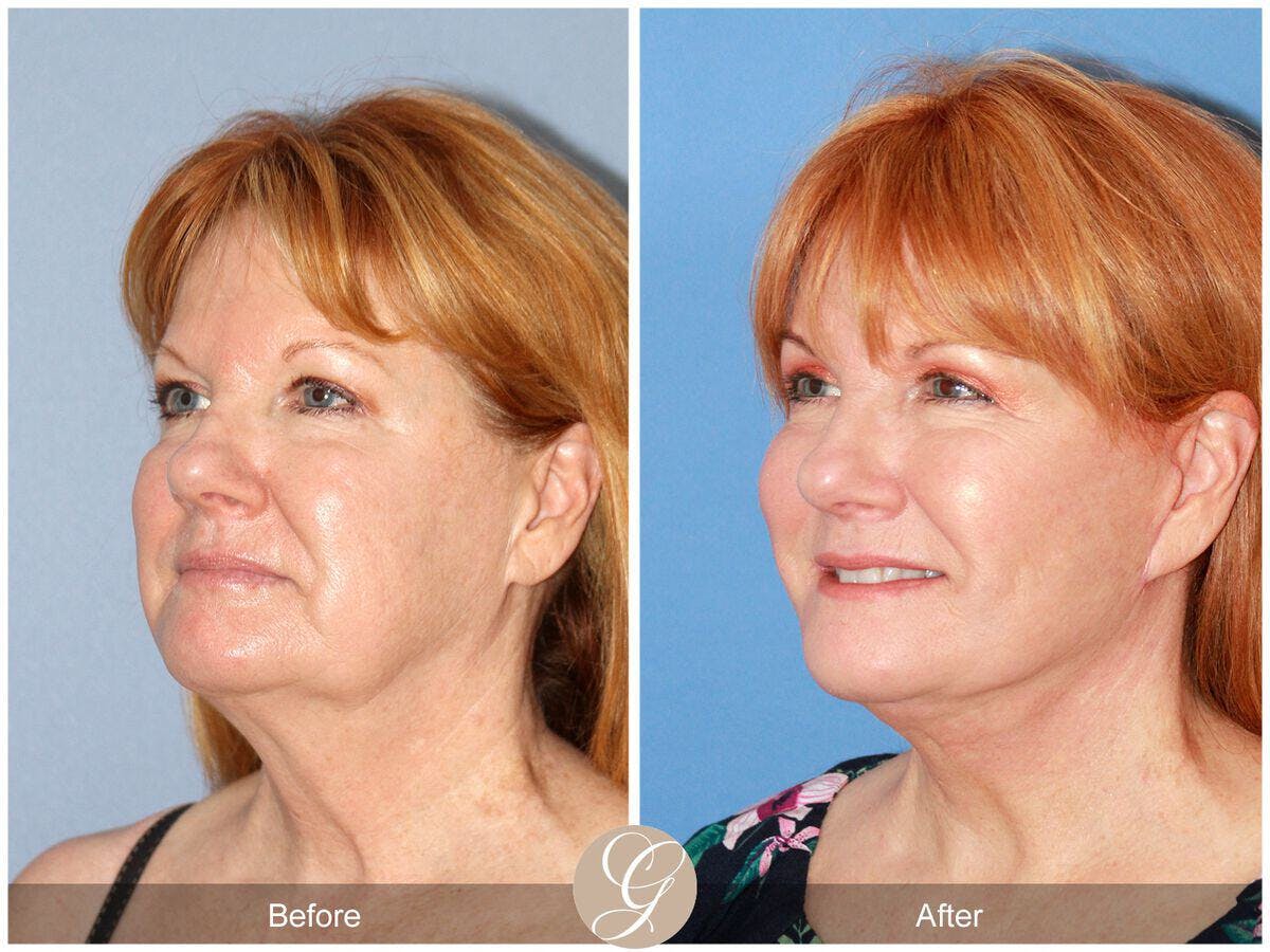 Eyelid Lift Before & After Gallery - Patient 868770 - Image 4