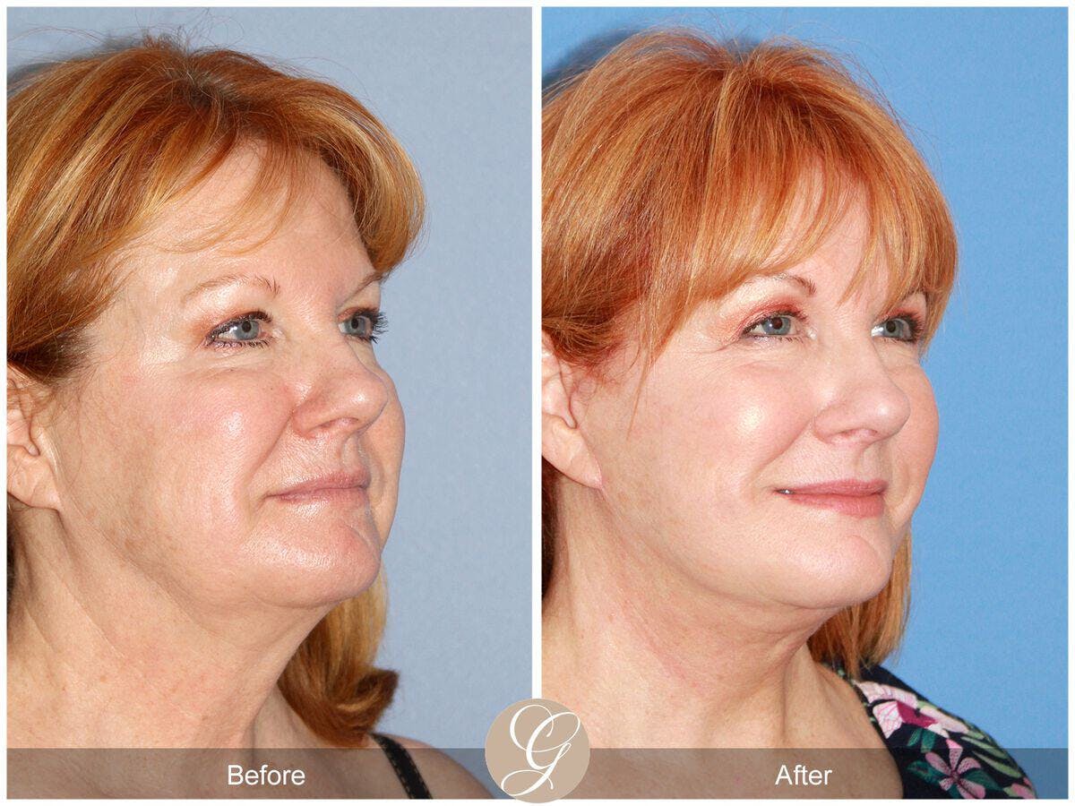 Eyelid Lift Before & After Gallery - Patient 868770 - Image 5