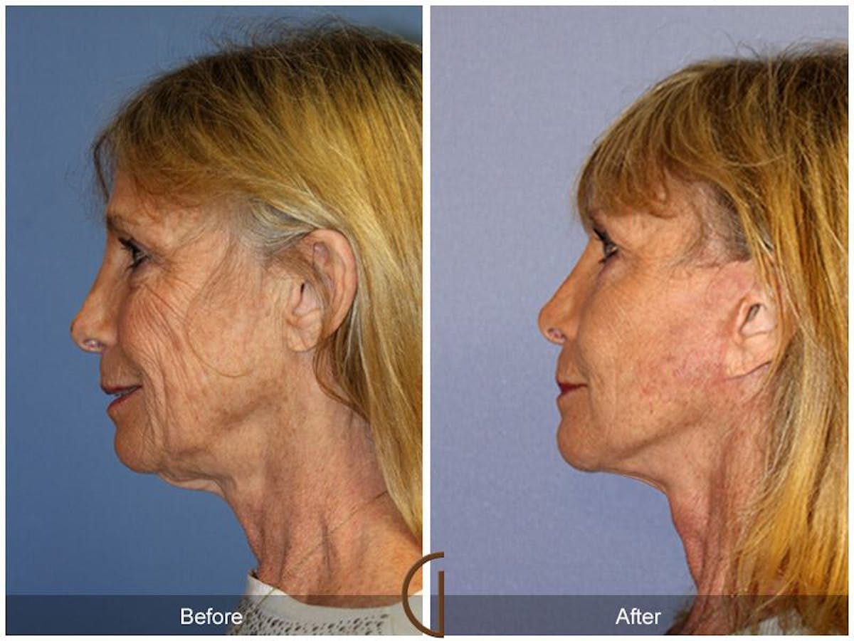 Eyelid Lift Before & After Gallery - Patient 612363 - Image 1