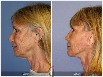 Eyelid Lift Before & After Gallery - Patient 612363 - Image 1