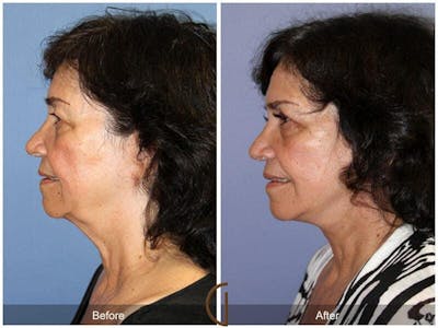 Eyelid Lift Before & After Gallery - Patient 211124 - Image 1